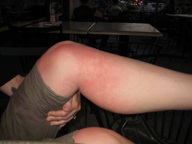 Heat Rashes